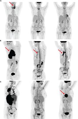 Two-Year Event-Free Survival Prediction in DLBCL Patients Based on In Vivo Radiomics and Clinical Parameters